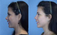 30 year old woman treated with Chin Implant
