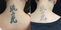 25-34 year old treated with Tattoo Removal