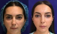 25-34 year old woman treated with Ultherapy