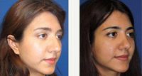 32 Year Old Woman Treated With Rhinoplasty Before By Dr Paul W. Papillion, MD, Nashville Plastic Surgeon