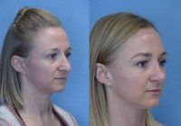 33 year old woman treated with a Cosmetic Rhinoplasty