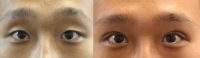 25-34 year old man treated with Double Eyelid Surgery