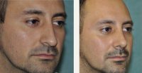 34 Year Old Man Treated With Rhinoplasty Before With Dr Laura Carmina Cardenas, MD, Mexico Plastic Surgeon