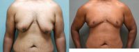 34 year old man who underwent gynecomastia excision after massive weight loss