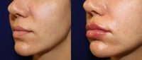 35 y/o female - lip augmentation with Juvederm Vollure