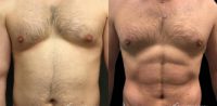 35-44 year old man treated with Vaser Liposuction