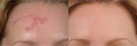 35-44 year old woman treated with Scar Removal