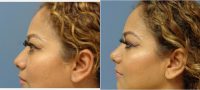 35 Year Old Woman Treated With Rhinoplasty Before With Doctor Chad Robbins, MD, Nashville Plastic Surgeon