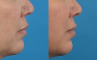 35-44 year old woman treated with Injectable Fillers