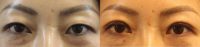 35-44 year old woman treated with Double Eyelid Surgery