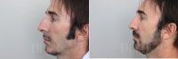 38 Year Old Man Treated With Rhinoplasty Before By Dr Pedram Imani, MBBS(Hons), MS(Hons), FRACS, Perth Facial Plastic Surgeon