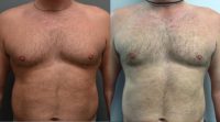 38 year old man who underwent liposuction for male breast reduction (gynecomastia)