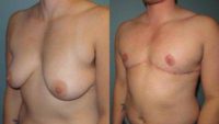 35-44 year old treated with mastectomy (Female to Male "Top" Surgery)