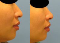 35-44 year old woman treated with Injectable Fillers