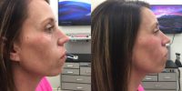 40 year old woman treated for midface deficiency