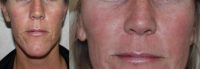 35-44 year old woman treated with Acne Scars Treatment