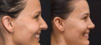 41 year old woman treated with Rhinoplasty