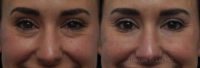 35-44 year old woman treated with Under-Eye Botox and Filler