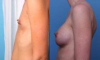 35-44 year old man treated with Breast Augmentation