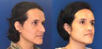 35-44 year old woman treated with MTF Facial Feminization Surgery