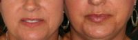 35-44 year old woman lip enhancement w/ 1 ml HA filler