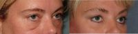 45 Year Old Upper And Lower Lid Blepharoplasty with Browlift