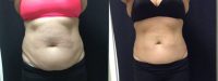 45-54 year old woman treated with CoolSculpting