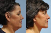 45-54 year old woman treated Facelift