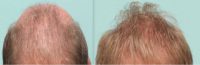 45-54 year old man treated with ARTAS Robotic Hair Transplant