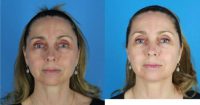 45-54 year old woman treated for rosacea
