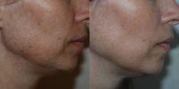 45-54 year old woman treated with Fractional Laser Resurfacing