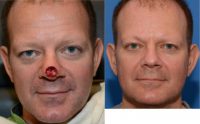 45-54 year old man treated with Facial Reconstructive Surgery
