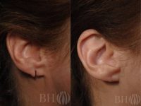 45-54 year old woman treated with Ear Lobe Surgery/Ear Lobe Repair