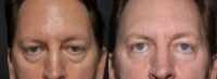 45-54 year old man treated with Eye Bags Treatment