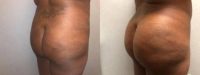 45-54 year old woman treated with Brazilian Butt Lift