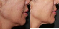 45-54 year old woman treated with FaceTite