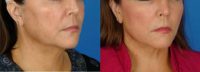 53 year old female treated with Ultherapy for jawline and neck