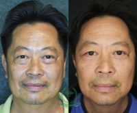 45-54 year old man treated with Eyelid Surgery