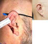 45-54 year old man treated with Ear Surgery