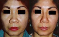 45-54 year old woman treated with Asian Rhinoplasty