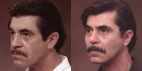 55-64 year old man treated with Facelift, Rhinoplasty and Cheek Implant