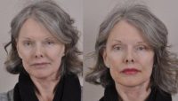 55-64 year old woman treated with Dermal Fillers and Injectables