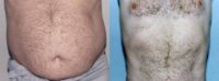 55-64 year old man treated with Liposuction