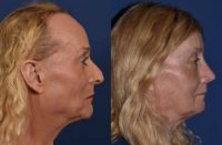 55-64 year old woman treated with Facial Feminization Surgery