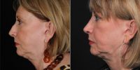 56 Year Old Woman Treated With Rhinoplasty Before By Doctor Michael R. Lee, MD, FACS, Dallas Plastic Surgeon