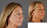 55-64 year old woman treated with MACS Facelift