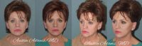 55-64 year old woman treated with Facelift Revision