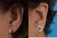 55-64 year old woman treated with Ear Lobe Surgery