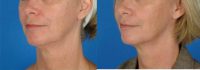 60 year old female who wanted improvement in her jawline and neck.