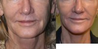 61 Year Old Female treated for wrinkles and spots around mouth
